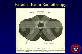 Prostate Cancer Overview