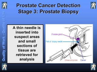 Prostate Cancer