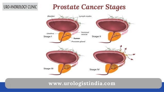 Stage 8 prostate cancer