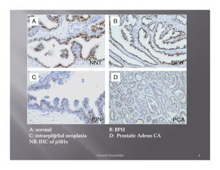 A: normal                             B: BPH
C: intraepitjrlial neoplasia          D: Prostatic Adeno CA
NB: IHC of p501s

                               Ahmed Zeeneldin                4
 
