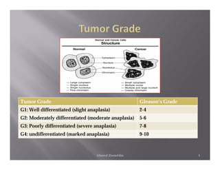 Tumor Grade                                          Gleason’s Grade
G1: Well differentiated (slight anaplasia)           2-4
G2: Moderately differentiated (moderate anaplasia)   5-6
G3: Poorly differentiated (severe anaplasia)         7-8
G4: undifferentiated (marked anaplasia)              9-10



                                   Ahmed Zeeneldin                     5
 