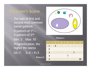 ¨   The sum of first and
    second most common
    tumor pattern
¨   G pattern of 1st +
    G pattern of 2nd
                                              Pattern 1
¨   Min: 2 Max: 10
                                          1        2      3   4   5
¨   Prognostication, the           1      2
    higher the worse               2
¨   GS=7:   3+4 > 4+3              3                          7
                                   4                      7
                   Pattern 2
                                   5                              10

                        Ahmed Zeeneldin                                7
 