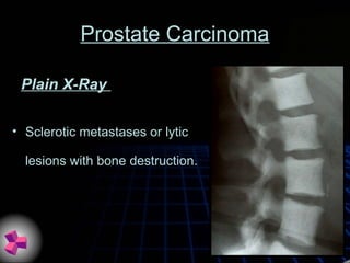 Prostate Carcinoma
• Sclerotic metastases or lytic
lesions with bone destruction.
Plain X-Ray
 