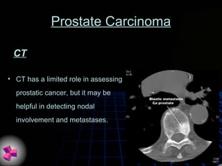 Prostate Carcinoma
• CT has a limited role in assessing
prostatic cancer, but it may be
helpful in detecting nodal
involvement and metastases.
CT
 