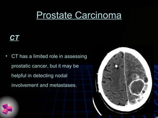 Prostate Carcinoma
• CT has a limited role in assessing
prostatic cancer, but it may be
helpful in detecting nodal
involvement and metastases.
CT
 
