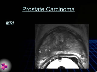Prostate Carcinoma
MRI
 