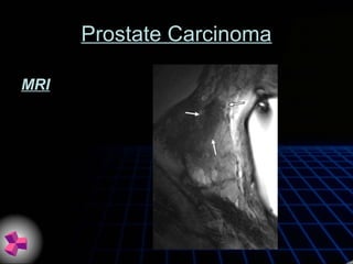 Prostate Carcinoma
MRI
 