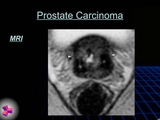 Prostate Carcinoma
MRI
 