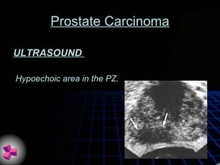 Prostate Carcinoma
ULTRASOUND
Hypoechoic area in the PZ.
 