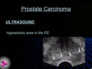 Prostate Carcinoma
ULTRASOUND
Hypoechoic area in the PZ.
 
