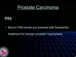 Prostate Carcinoma
• Serum PSA levels are lowered with finasteride
treatment for benign prostatic hyperplasia
PSA
 