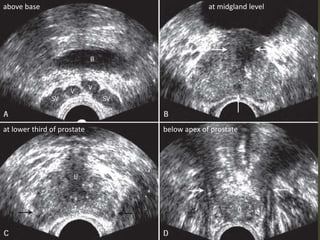 above base at midgland level
at lower third of prostate below apex of prostate
 
