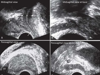 Midsagittal view Midsagittal view at base
Parasagittal view above the prostateParasagittal view
 