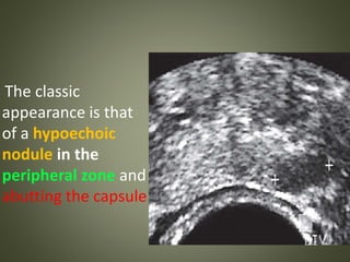 The classic
appearance is that
of a hypoechoic
nodule in the
peripheral zone and
abutting the capsule
 