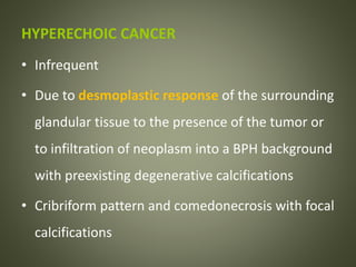 HYPERECHOIC CANCER
• Infrequent
• Due to desmoplastic response of the surrounding
glandular tissue to the presence of the tumor or
to infiltration of neoplasm into a BPH background
with preexisting degenerative calcifications
• Cribriform pattern and comedonecrosis with focal
calcifications
 
