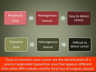 Peripheral
Zone
Homogenous
texture
Easy to detect
cancer
Transition
Zone
Heterogenous
texture
Difficult to
detect cancer
Clues to transition zone cancer are the identification of a
poorly marginated hypoechoic area that appears different
from other BPH nodules and the focal loss of surgical capsule.
 