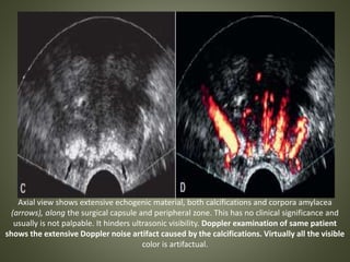 Axial view shows extensive echogenic material, both calcifications and corpora amylacea
(arrows), along the surgical capsule and peripheral zone. This has no clinical significance and
usually is not palpable. It hinders ultrasonic visibility. Doppler examination of same patient
shows the extensive Doppler noise artifact caused by the calcifications. Virtually all the visible
color is artifactual.
 