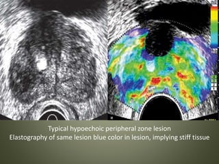 Typical hypoechoic peripheral zone lesion
Elastography of same lesion blue color in lesion, implying stiff tissue
 