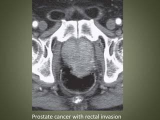 Prostate cancer with rectal invasion
 