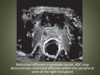 Restricted diffusion in prostate cancer. ADC map
demonstrates restricted diffusion within the peripheral
zone of the right mid-gland
 