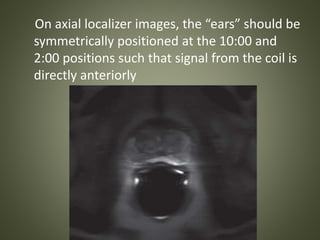 On axial localizer images, the “ears” should be
symmetrically positioned at the 10:00 and
2:00 positions such that signal from the coil is
directly anteriorly
 