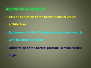 SEMINAL VESICLE INVASION
• Loss or disruption of the normal seminal vesicle
architecture
• Replacement of the T2-hyperintense seminal vesicle
with hypointense tumor
• Obliteration of the normal prostate–seminal vesicle
angle
 