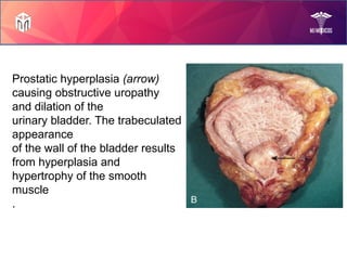 Prostate Diseases by Mam Rabia!.pptx slides | PPTX
