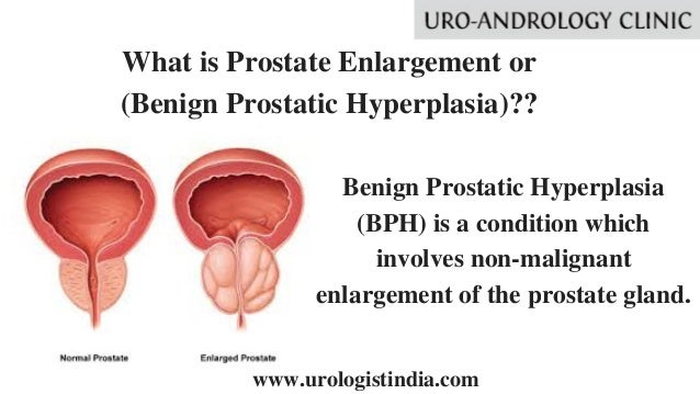 Prostate Enlargement Treatment In Tamil Nadu Best Urologist In Ind