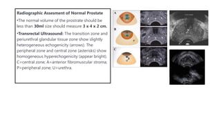 Normal Prostate Dimensions PROSTATE ENLARGEMENT: BPH and prostate cancer.pptx