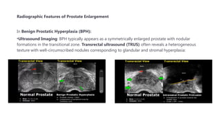 PROSTATE ENLARGEMENT: BPH and prostate cancer.pptx