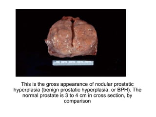PROSTATE GLAND-1.ppt777777777777777777777777777777 | PPT