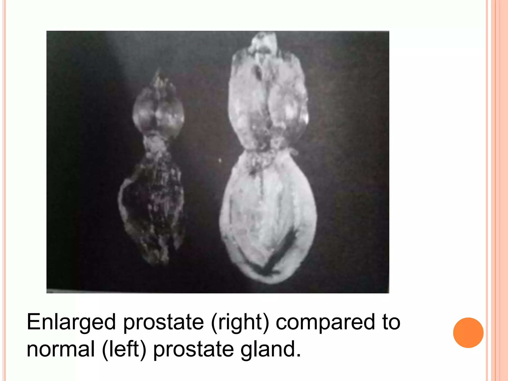 Enlarged prostate (right) compared to
normal (left) prostate gland.