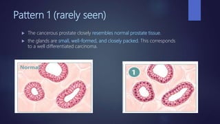 Prostate Pattern D Prostate imaging | PPTX