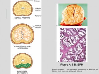 Rubin's Pathology : Clinicopathologic Foundations of Medicine, 5th
Edition, 2008 Lippincott Williams & Wilkins
Figure A & ...