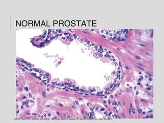 NORMAL PROSTATE
Picture Taken from Robbins and Cotran Pathologic basis of disease. 8th
edition, Chapter 21, 2010 Sanders
 