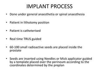 IMPLANT PROCESS
• Done under general anaesthetia or spinal anaesthesia
• Patient in lithotomy position
• Patient is catheterised
• Real time TRUS guided
• 60-100 small radioactive seeds are placed inside the
prostate
• Seeds are inserted using Needles or Mick applicator guided
by a template placed over the perineum according to the
coordinates determined by the preplan
 