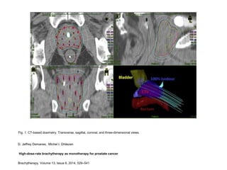 D. Jeffrey Demanes, Michel I. Ghilezan
High-dose-rate brachytherapy as monotherapy for prostate cancer
Brachytherapy, Volume 13, Issue 6, 2014, 529–541
Fig. 1. CT-based dosimetry. Transverse, sagittal, coronal, and three-dimensional views.
 