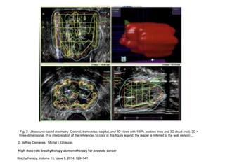 D. Jeffrey Demanes, Michel I. Ghilezan
High-dose-rate brachytherapy as monotherapy for prostate cancer
Brachytherapy, Volume 13, Issue 6, 2014, 529–541
Fig. 2. Ultrasound-based dosimetry. Coronal, transverse, sagittal, and 3D views with 100% isodose lines and 3D cloud (red). 3D =
three-dimensional. (For interpretation of the references to color in this figure legend, the reader is referred to the web version ...
 