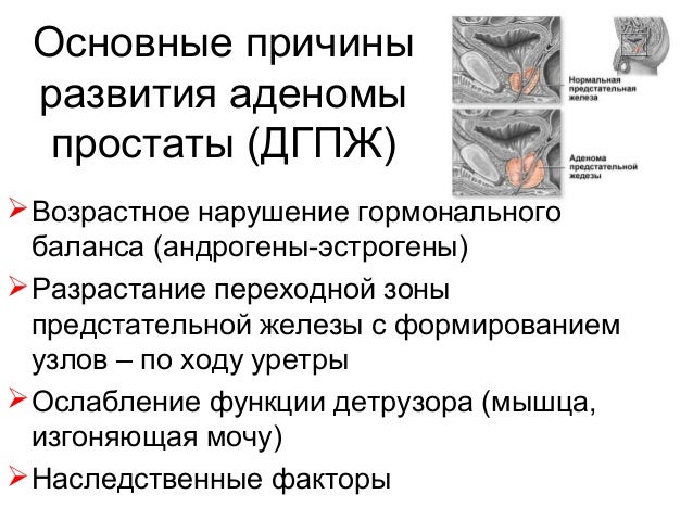Удаление аденомы простаты Клиника урологии Первого МГМУ