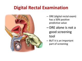 Digital Rectal Examination
– DRE (digital rectal exam)
has a 50% positive
predictive value
–DRE alone is not a
good screening
tool
– BUT it is an important
part of screening
 