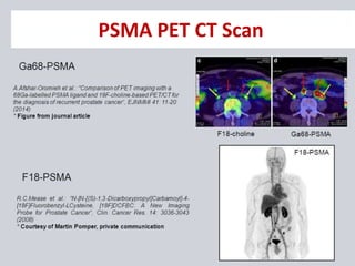 PSMA PET CT Scan
 