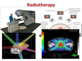 Radiotherapy
 