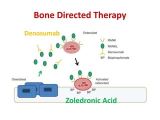 Bone Directed Therapy
Zoledronic Acid
Denosumab
 