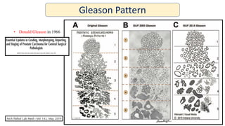 Modified Gleason Prostate updates | PPTX