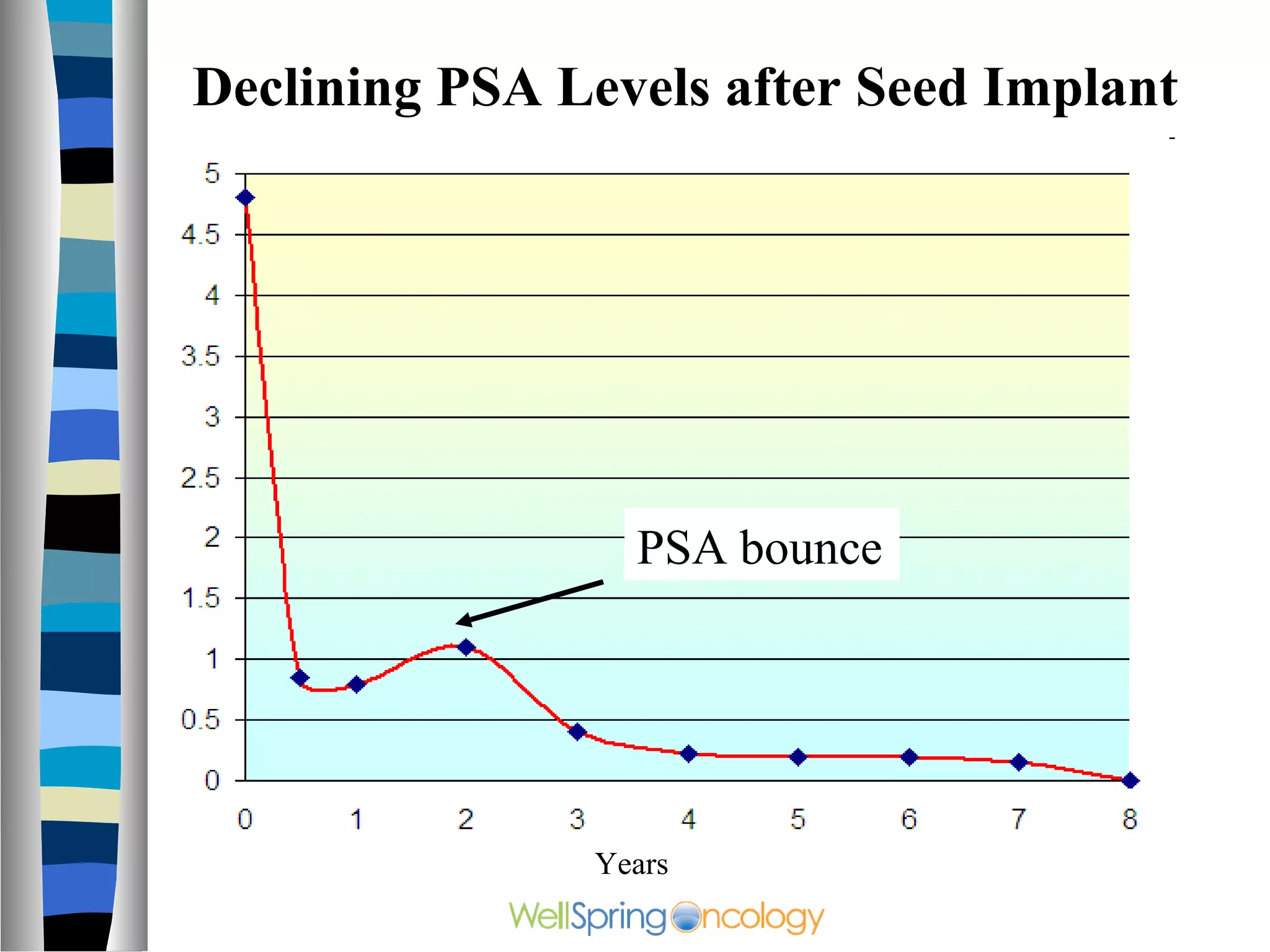 Declining PSA Levels after Seed Implant




                 PSA bounce




               Years
 