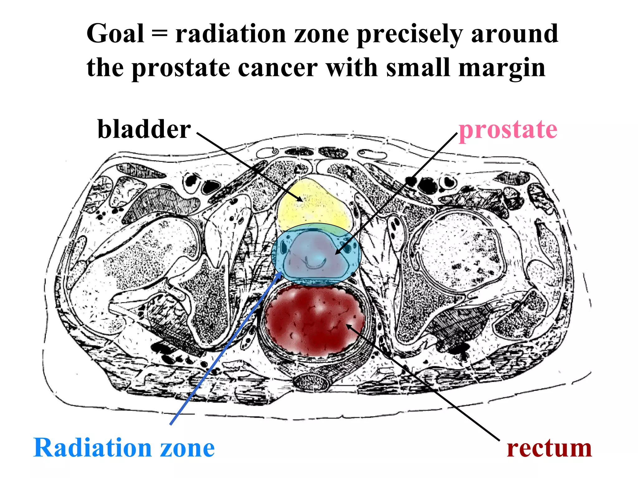 Goal = radiation zone precisely around
    the prostate cancer with small margin

    bladder                      prostate




Radiation zone                       rectum
 