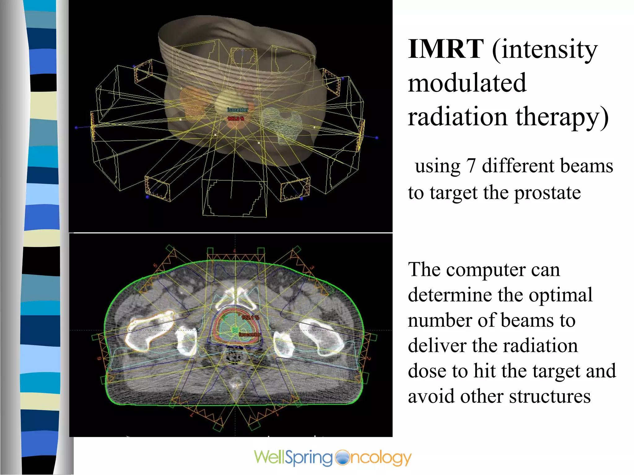 IMRT (intensity
modulated
radiation therapy)
 using 7 different beams
to target the prostate


The computer can
determine the optimal
number of beams to
deliver the radiation
dose to hit the target and
avoid other structures
 