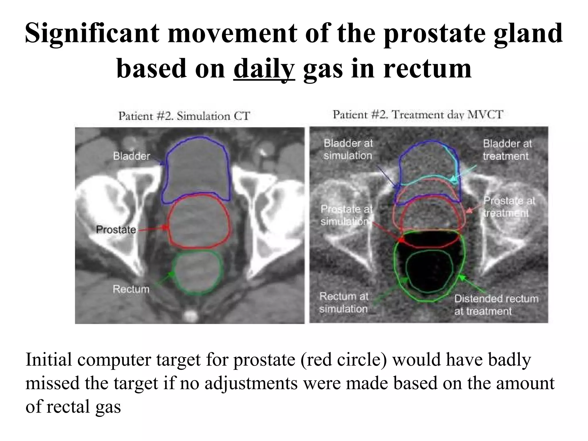 Significant movement of the prostate gland
        based on daily gas in rectum




Initial computer target for prostate (red circle) would have badly
missed the target if no adjustments were made based on the amount
of rectal gas
 