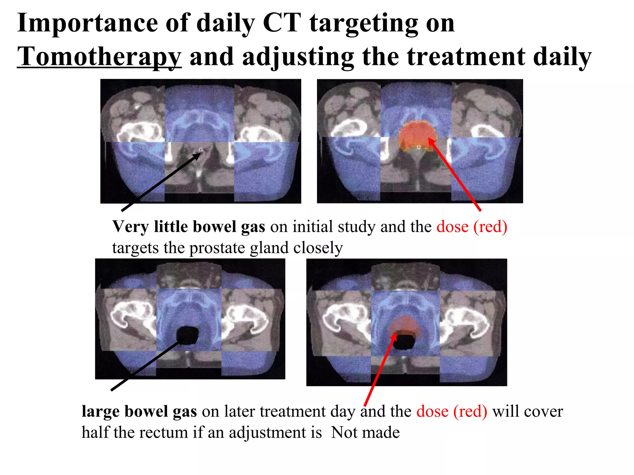 Importance of daily CT targeting on
Tomotherapy and adjusting the treatment daily




         Very little bowel gas on initial study and the dose (red)
         targets the prostate gland closely




     large bowel gas on later treatment day and the dose (red) will cover
     half the rectum if an adjustment is Not made
 