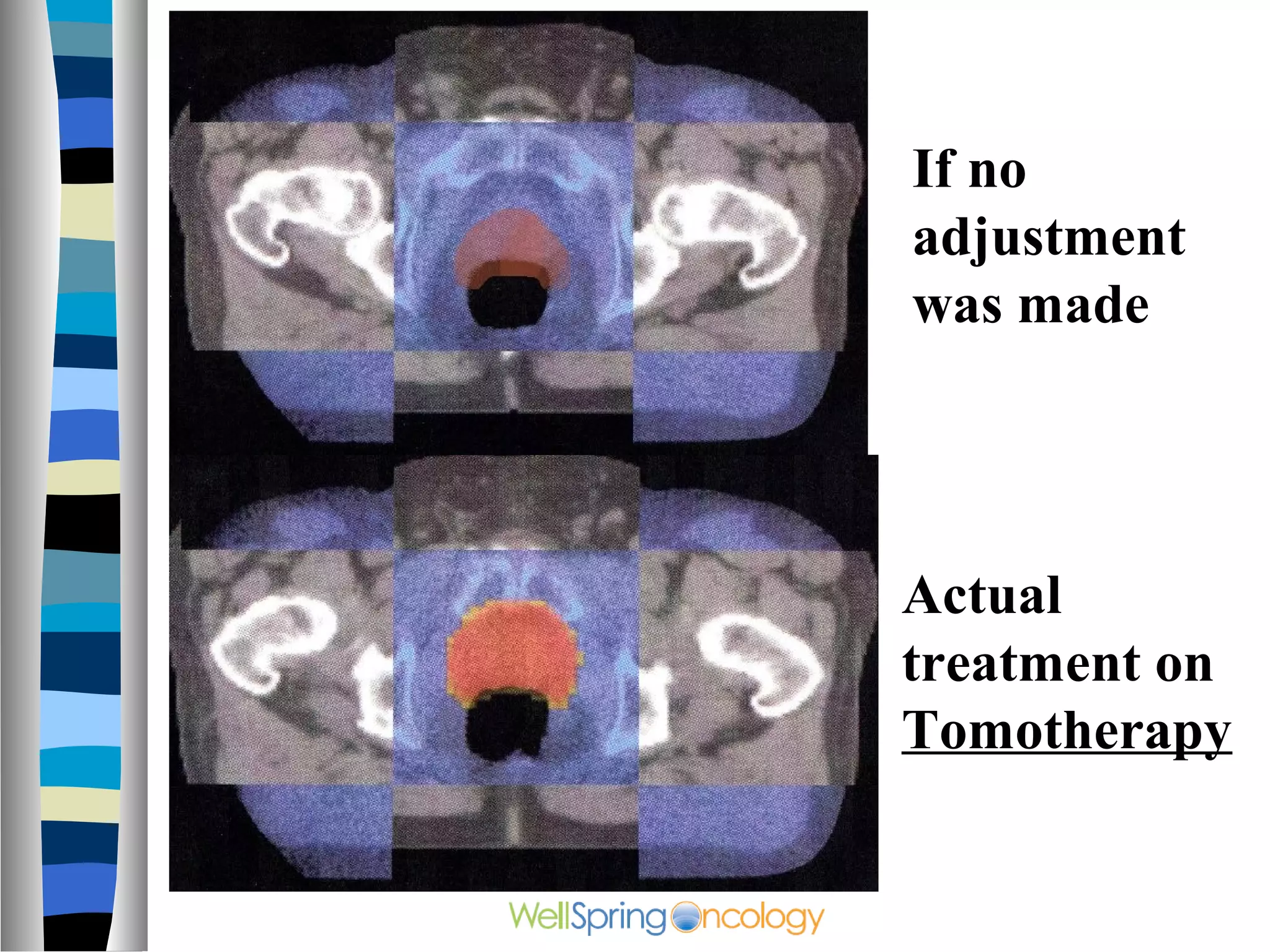 If no
adjustment
was made




Actual
treatment on
Tomotherapy
 